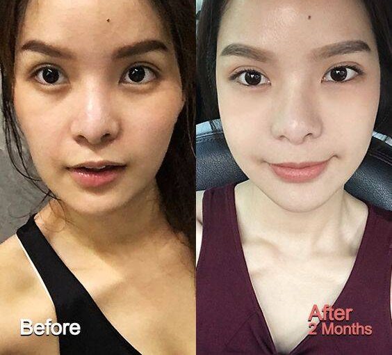 collagen cheek injections