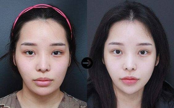 collagen cheek injections