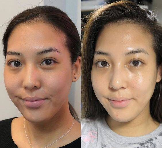 collagen cheek injections