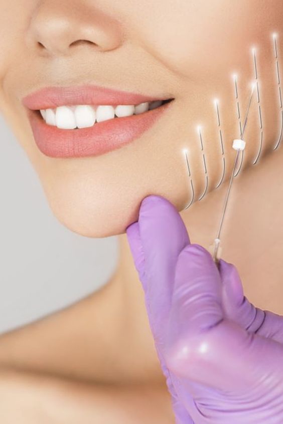 Collagen Thread Lift