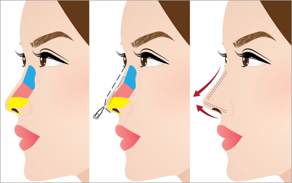 Comparing Nose Thread Lift to Surgical Rhinoplasty