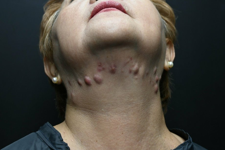 Complications of chin fat reduction filler injection