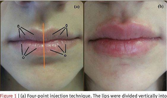 lip filler injection points