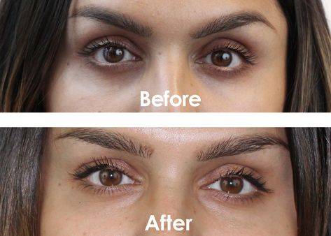 Dark Circles Under Eyes Treatment