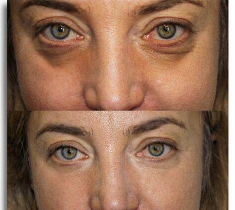 Dark Circles Under Eyes Treatment