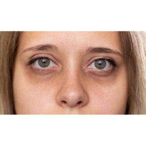 Dark Circles Under Eyes Treatment