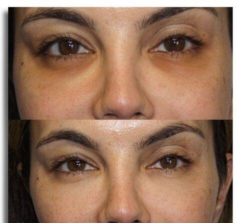 Dark Circles Under Eyes Treatment