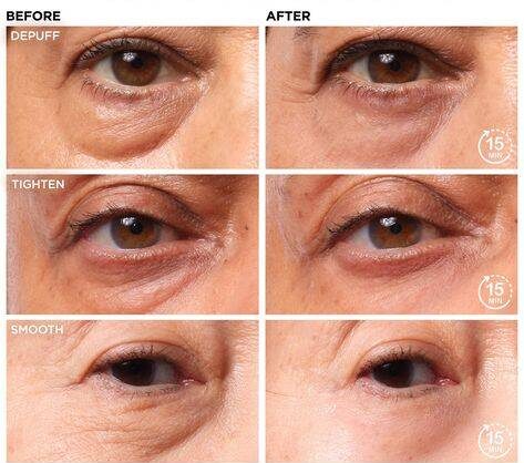 Dark Circles Under Eyes Treatment