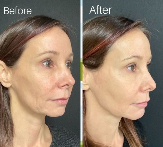 dermal filler before and after