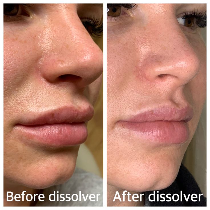 Dermal Filler Dissolver Before and After