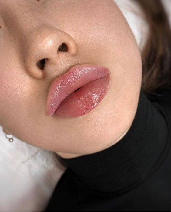 lip filler injection points