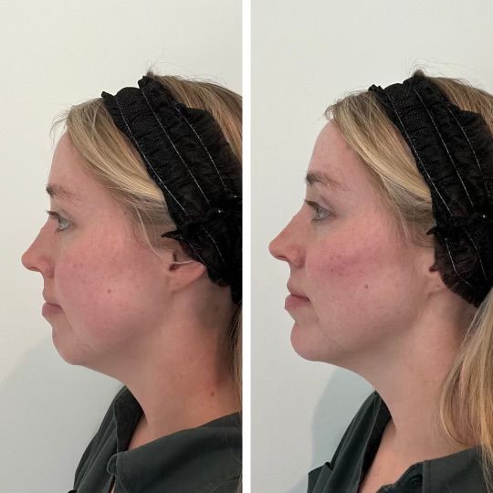 Effective Chin Lift with Thread