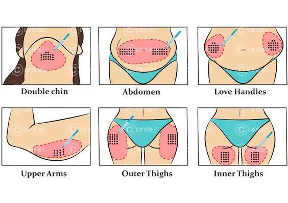 fat dissolving injection