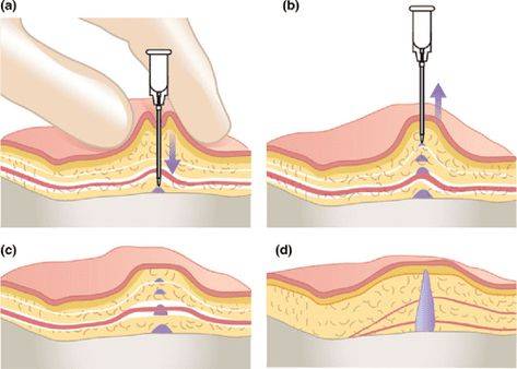 fat dissolving injection