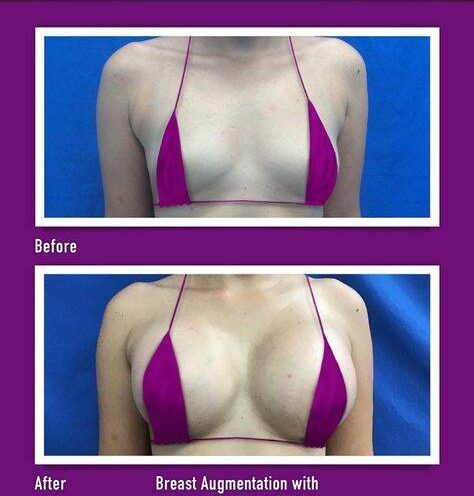 fat injection breast augmentation