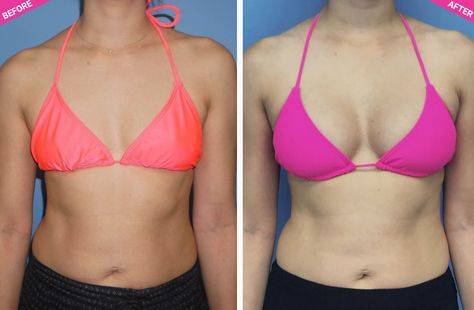 fat injection breast augmentation