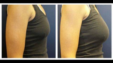 fat injection breast augmentation