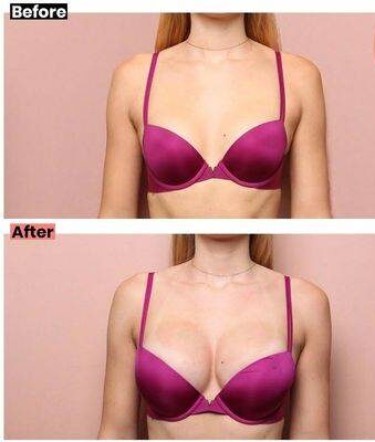 fat injection breast augmentation