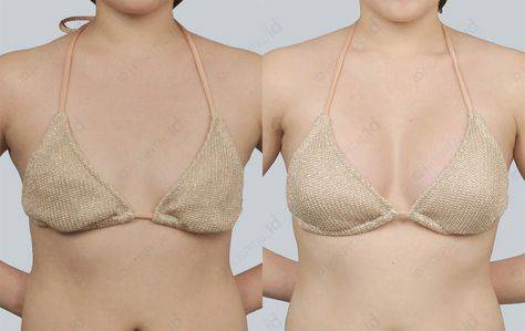 fat injection breast enlargement