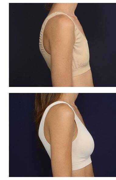 fat injection breast enlargement