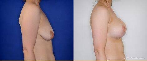 fat injection breast enlargement