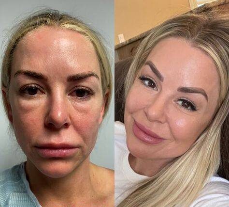 fat injections in face