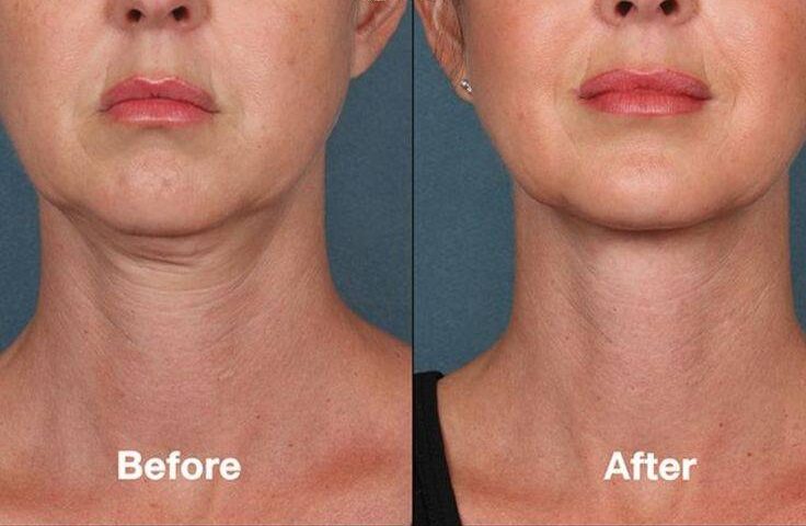 fat injections in face