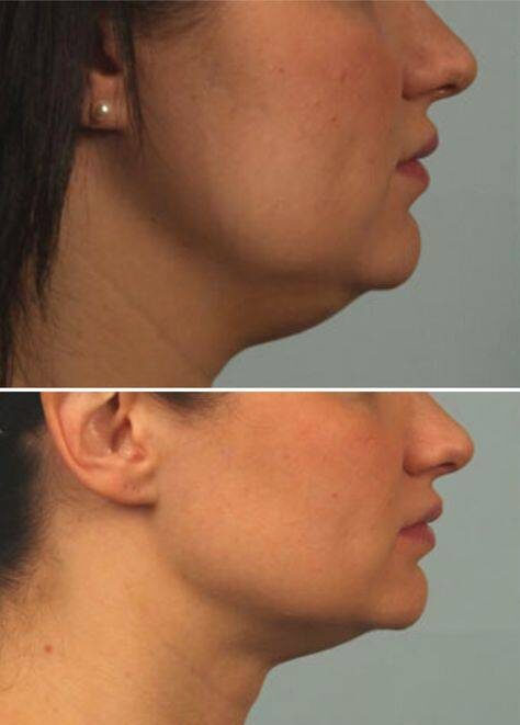 fat injections in face