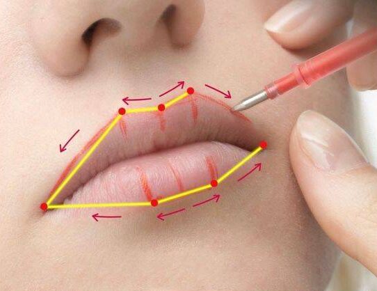 lip filler injection points