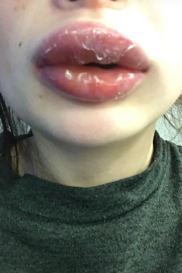 Flaky swollen lips due to infection