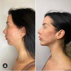 how long do cheek injections last