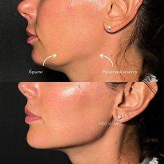 how long do cheek injections last