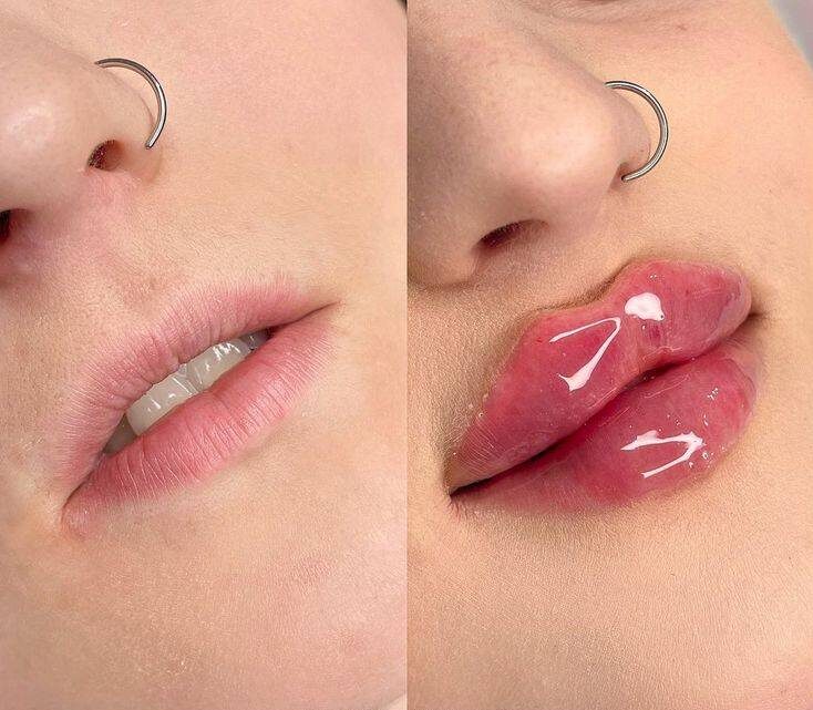 how long does hyaluronic acid lip filler last