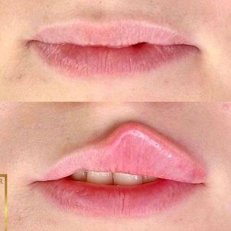 how long does hyaluronic acid lip filler last