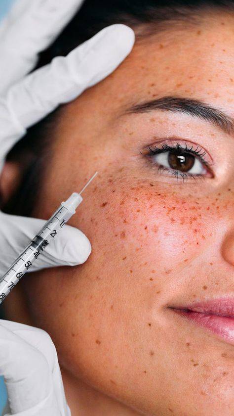 how long should botox last