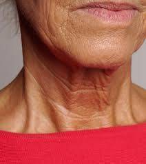 how to get rid of lines on neck