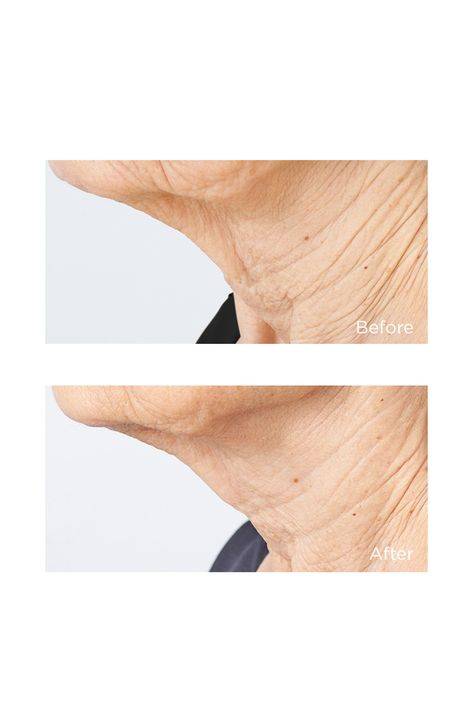 how to get rid of lines on neck