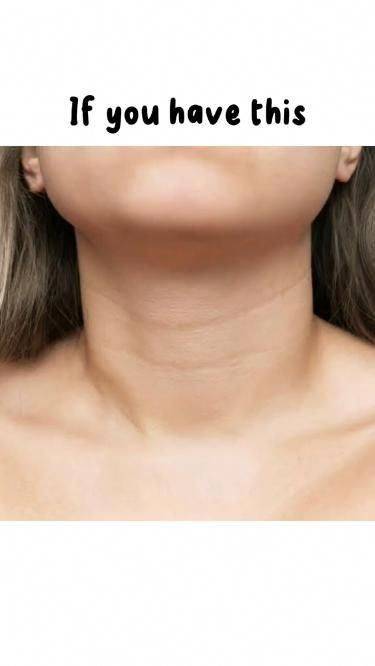 How to get rid of neck lines