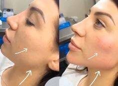 how to inject dermal fillers in cheeks