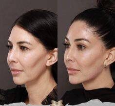 how to inject dermal fillers in cheeks