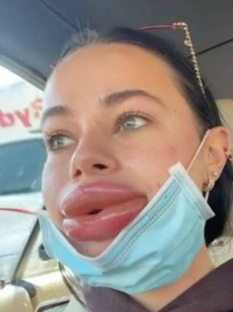 allergic reaction to lip injections