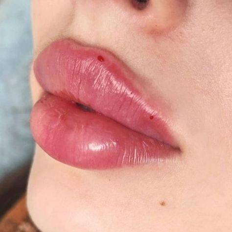 allergic reaction to lip injections