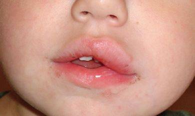 allergic reaction to lip injections