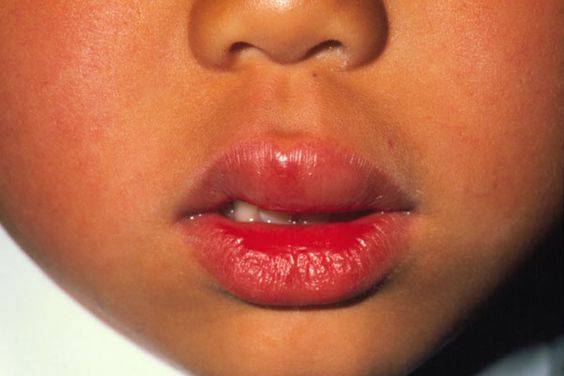 allergic reaction to lip injections