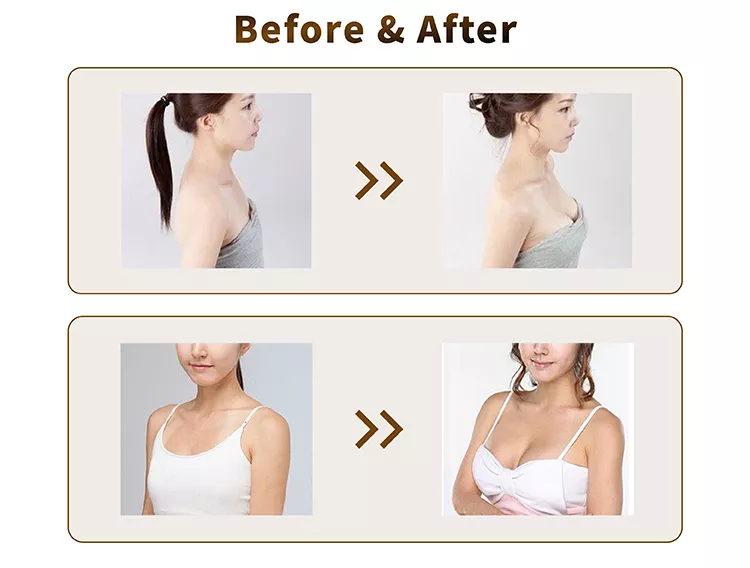 Hyaluronic Acid Breast Filler Before and After