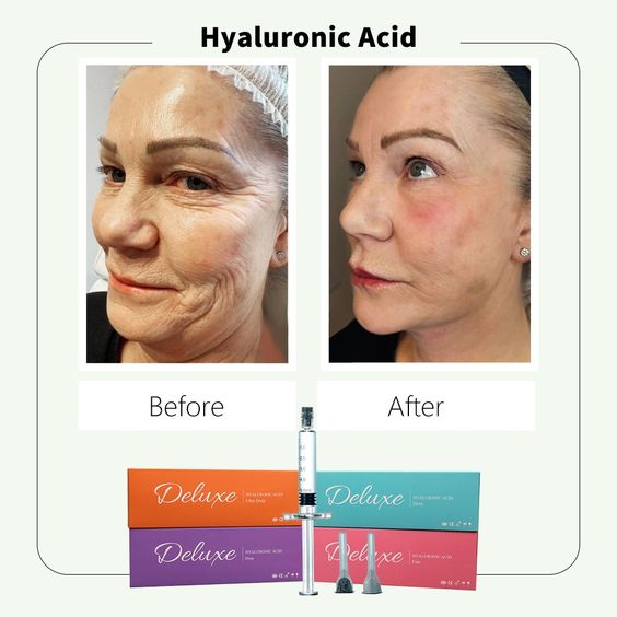 Hyaluronic Acid Fillers