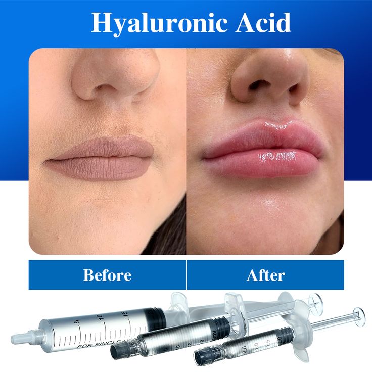 hyaluronic acid fillers