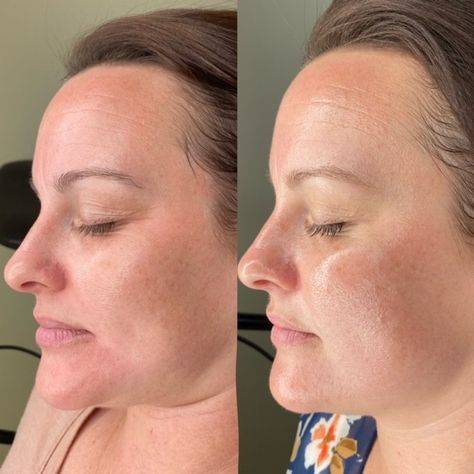 hydra needle facial before and after