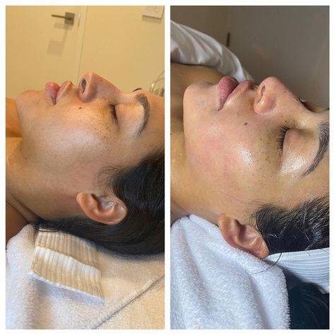 hydra needle facial before and after