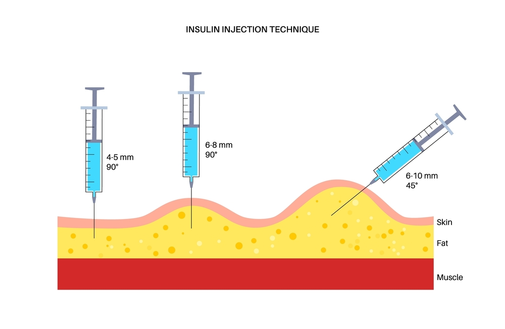 Incorrect Injection Technique